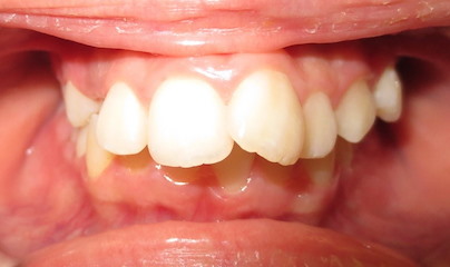 Common Orthodontic Issues | Bite & Alignment Solutions